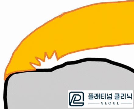 (플래티넘의원) 회전근개부분파열 골수자극 줄기세포 재생술로 수술 없이 치료가 가능합니다