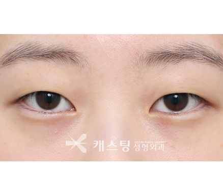 부천성형외과 첫 쌍수 100% 실패하지 않는 법 : 네이버 블로그