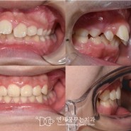 어린이 치아교정, 치아배열뿐 아니라 교합까지 고려해야 하는 이유