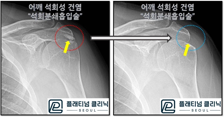 (플래티넘정형외과) 어깨 석회성 건염은 석회분쇄흡입술로 치료될 수 있습니다.