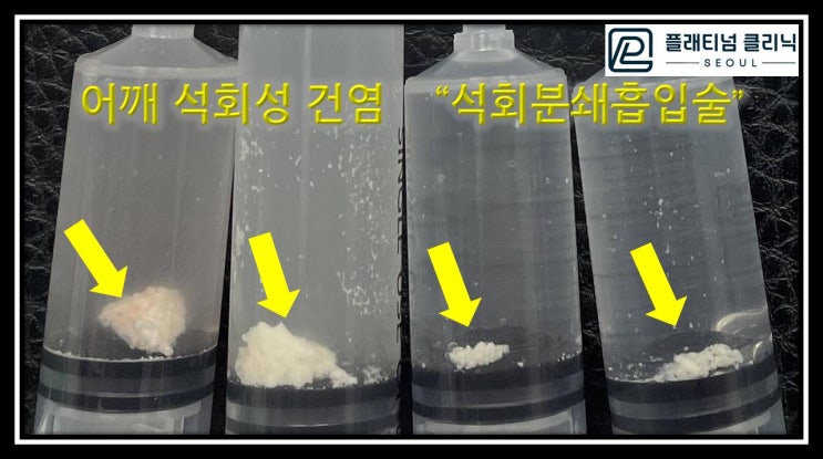 (플래티넘의원) 단단한 석회도 석회분쇄흡일술로 한번에 제거가 가능합니다.