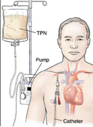 TPN,완전비경구영양 Total Parenteral Nutrition의 모든 것 정리 : 네이버 블로그