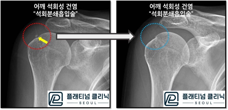 (플래티넘의원) 작고 단단한 석회라도 석회분쇄흡입술로 제거할 수 있습니다.
