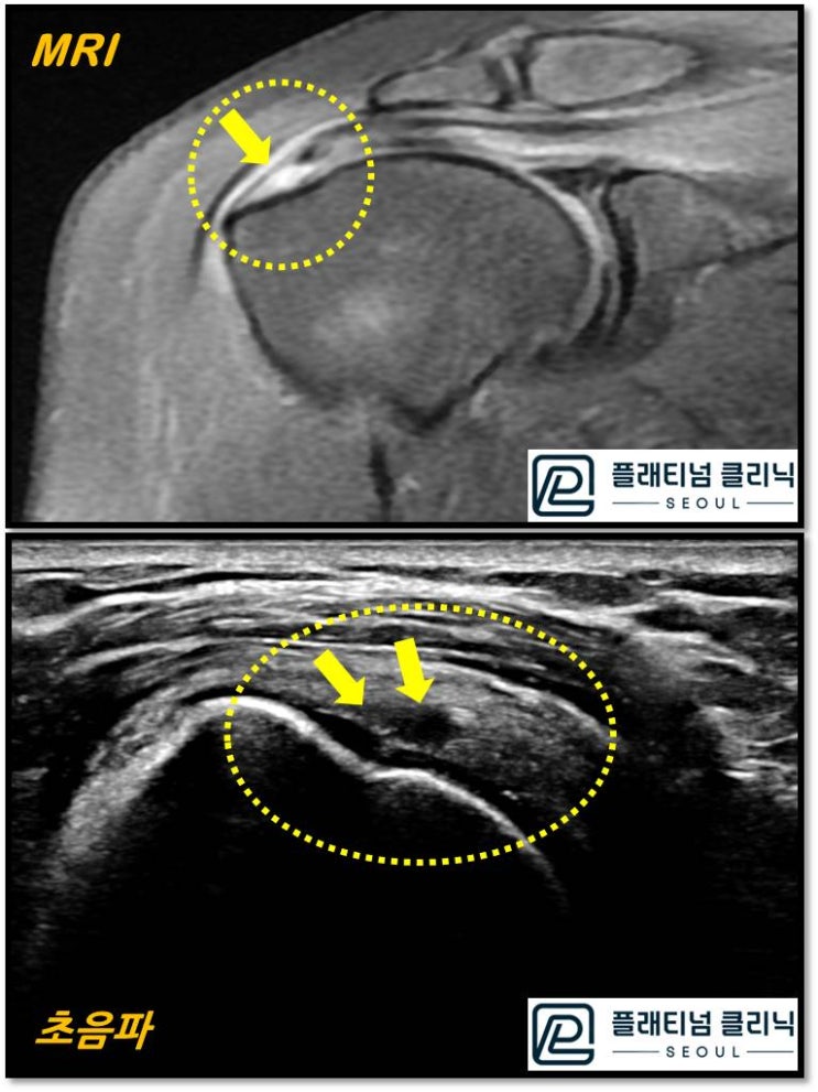 (플래티넘의원) 회전근개 질환 진단시 초음파 만으로도 충분히 진단이 가능합니다.
