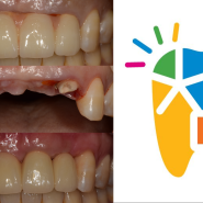 호매실치과 임플란트, 가이드 수술(guided surgery, 네비게이션임플란트?)로 부러진 앞니 발치 즉시 임플란트 식립과 당일 임시브리지 장착까지