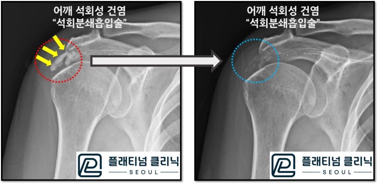 (플태티넘 의원) 의사도 어깨 석회성 건염 수술없이 석회분쇄흡입술로 치료받습니다.