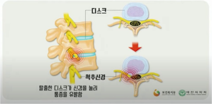 요추 추간판탈출증에서 탈출하자 '맥켄지 운동법' : 네이버 블로그