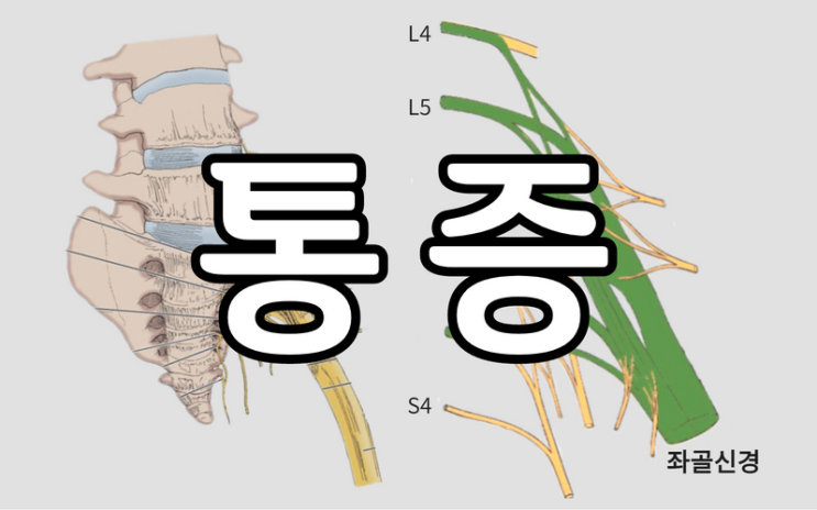 대전좌골신경통 원인 증상 이상근증후군 도안동한의원에서 : 네이버 블로그