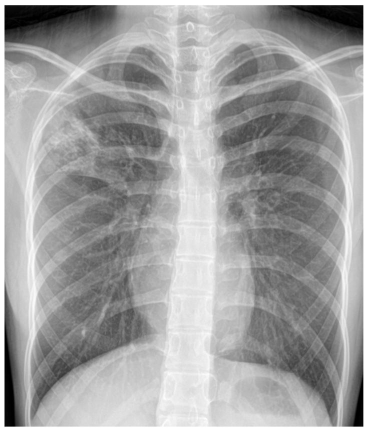 활동성 폐결핵 엑스레이 증례, 공동성 결절, 결핵 x-ray 소견 : 네이버 블로그