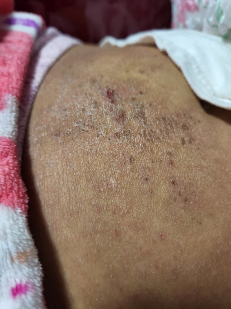 끔찍한 중증 아토피, 최악의 발악중(a serious adult case suffering from an atopic ...