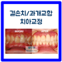 화곡역 치과 과개교합 결손치 치아교정