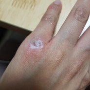 30대여자 손등사마귀치료 영등포계피부과 ,베루말액 처발처발