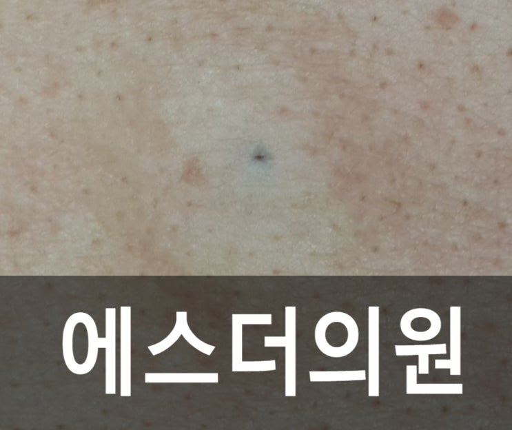 수원 피지낭종 에스더의원 등 표피낭종 제거[수원표피낭종제거수술핀홀법/신경섬유종/화서동고등동피부과/권선구팔달구영통광교용인안양의왕 ...
