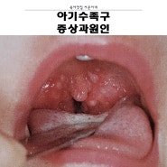 아기 수족구 증상과 원인