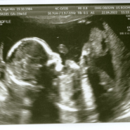 [캐나다 임신일기] #6 2차 기형아 검사 (19주 1일/5개월)