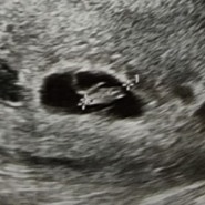 임신9주6일 아기 심장소리 멈춤. 첫 유산 소파술 전날