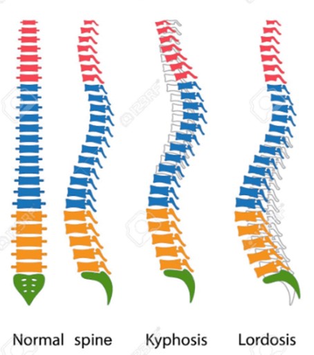 향동필라테스 척추전만(요추전만) 척추후만(흉추후만) Lordosis kyphosis posture 자세에 대하여 알아보자 ...