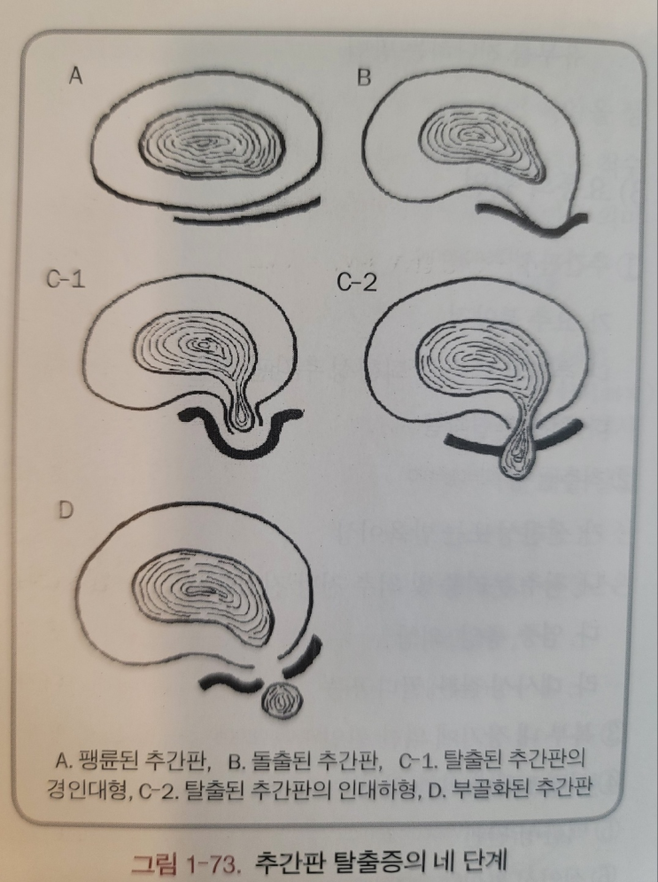 [허리통증] 요추 추간판 탈출증의 분류 : 네이버 블로그