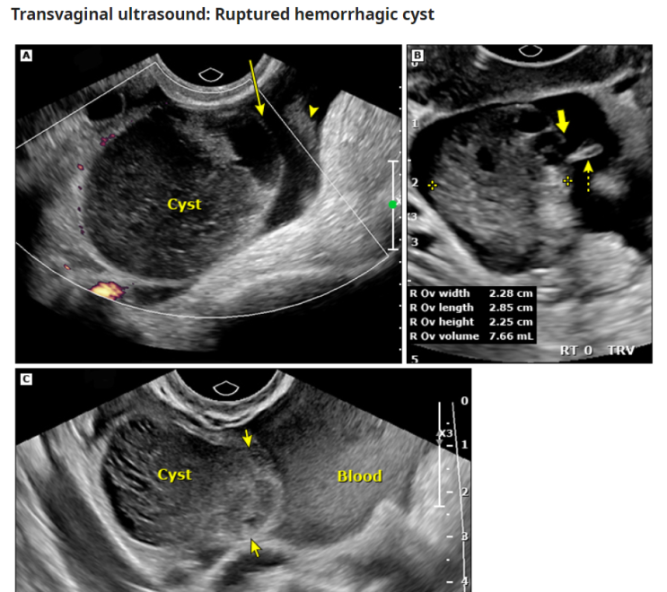 Ruptured ovarian cyst(난소 낭종 파열), Hemoperitoneum(혈복강) 네이버 블로그