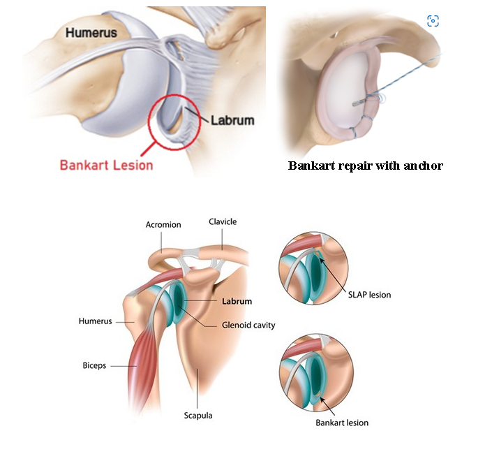 Bankart repair : 네이버 블로그