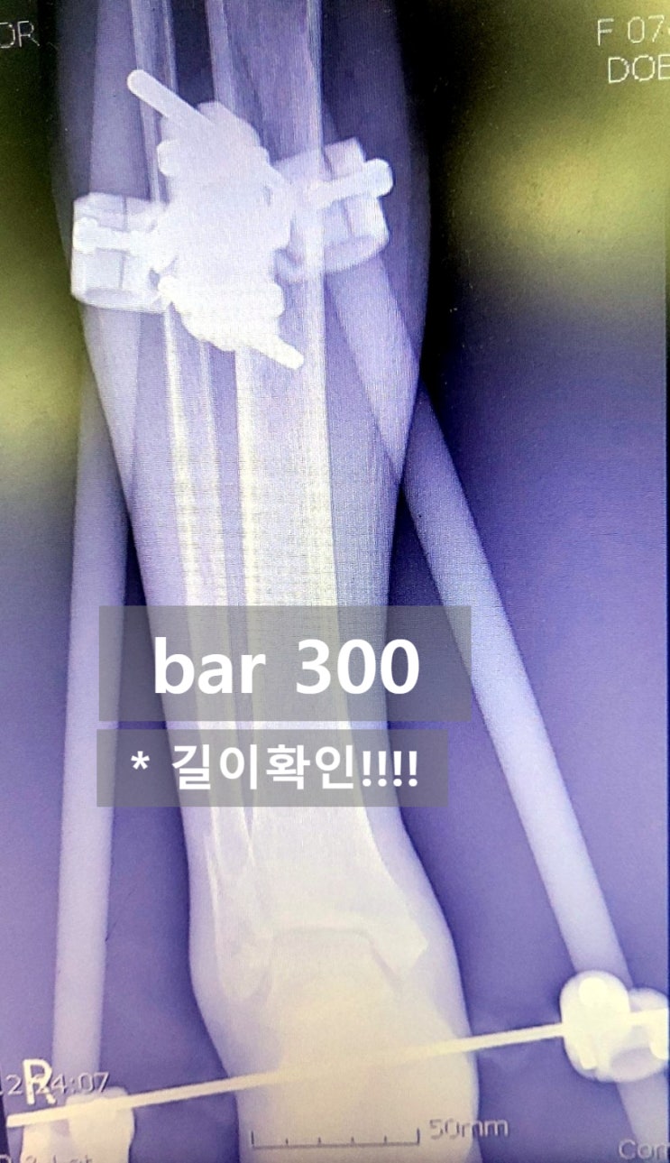 External Fixation (Ex Fix) : tibia : 네이버 블로그