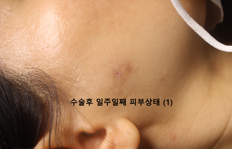 넓어진 모공에서 나오는 피지, 얼굴 표피낭종 수술과정, 레이디유외과[2022년7월] : 네이버 블로그