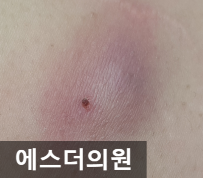 에스더의원 허벅지 표피낭종 제거 [수원피지낭종수원표피낭종제거수술핀홀법/화서동고등동피부과/권선구팔달구영통광교용인안양의왕군포화성동탄 ... 에스더의원 허벅지 표피낭종 제거 [수원피지낭종수원표피낭종제거수술핀홀법/화서동고등동피부과/권선구팔달구영통광교용인안양의왕군포화성동탄 ...