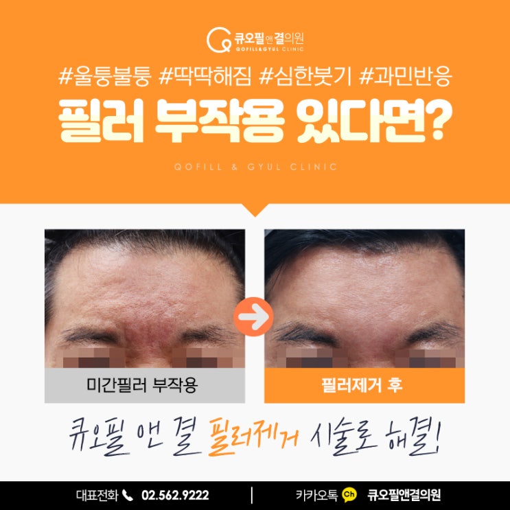 미간필러제거 방법 고민 중이라면? : 네이버 블로그