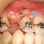 매복치의 치아교정 치료, 남양주 다산 치아교정 치과