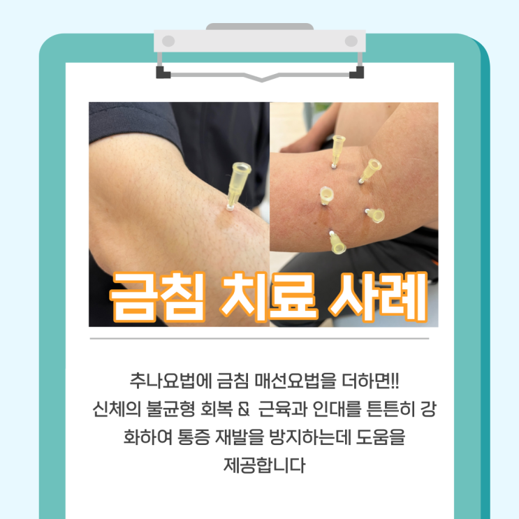 추나치료와 금침으로 팔꿈치 통증을? [부산 연산역 척마디한의원] : 네이버 블로그