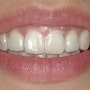 다산 치과, 투명교정 장치 장/단점 설명