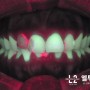 앞니 레진변색과 치아사이충치, 라미네이트와 올세라믹 크라운치료 (+치아교정 필요한 이유)