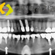 해운대 치과, 처음 수술로 재수술임플란트 안하려면