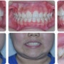 전주 어린이 조기 교정치료 (Early orthodontic treatment)