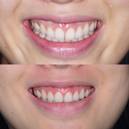 웃을 때 잇몸 많이 보이는 거미스마일, 간단한 치아성형과 치은절제술 + 보톡스 치료를 통해