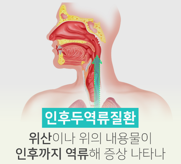 인후두 역류질환(Laryngopharyngeal reflux disease, LPRD) - 목이 갑갑하고 불편해요, 목 안쪽이 ...