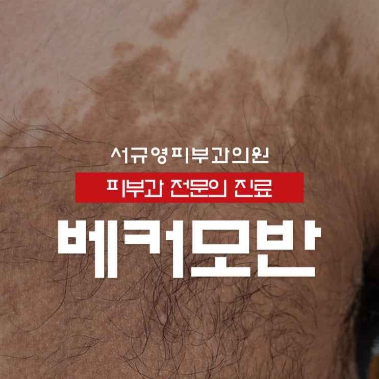 다모증 있는 베커모반 (베커씨모반)의 치료_ QX-MAX저출력치료+제모 : 네이버 블로그