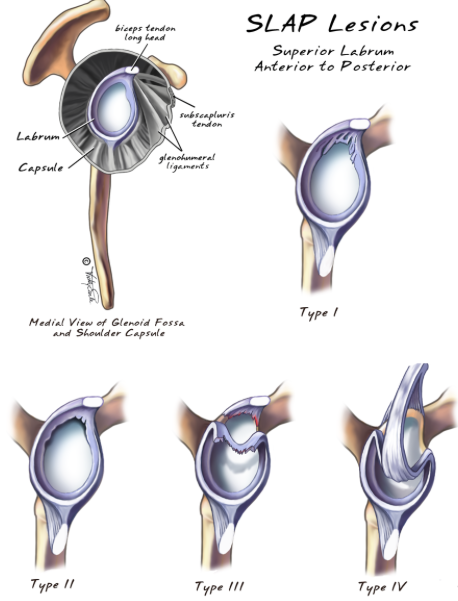 오브라이언 테스트(O'brien test), Labrum tear test : 네이버 블로그