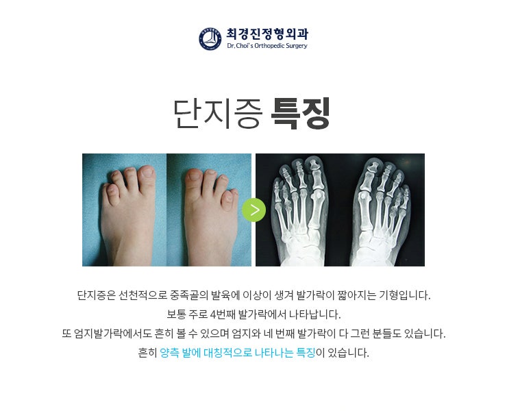 새끼발가락 단지증 치료 방법, 수술에 대해 : 네이버 블로그