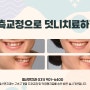 일산치아교정, 일산연치과 설측교정으로 덧니치료하기