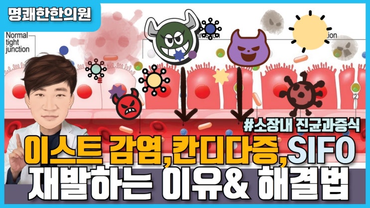 자꾸 재발하는 이스트감염/칸디다증/SIFO(소장내 진균[곰팡이] 과증식증)의 실체 & 치료법 : 네이버 블로그