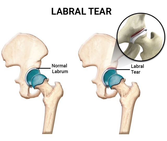 FADDIR-test 파디르검사,(Anterior labral tear test) : 네이버 블로그