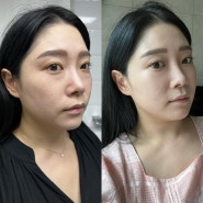 스테로이드없는 얼굴 윤곽주사 3회효과 (1회 7~11일차 ) NS 추천