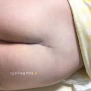 신생아 딤플 | 생후 4개월 딤플 소견(ft.2차 영유아검진) | 아기 엉덩이 딤플