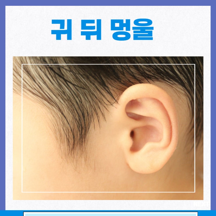 귀 뒤 멍울 귀뒤 피지낭종 임파선염 지방종 : 네이버 블로그