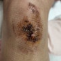 [상처 봉합 수술 후기] 양쪽 무릎 꿰맨 상처 관리, 셀프 소독
