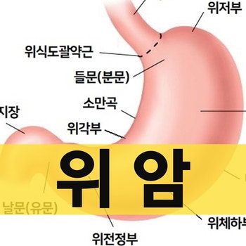 위암 분류, 초기 증상, 위내시경 진단 및 치료 : 네이버 블로그