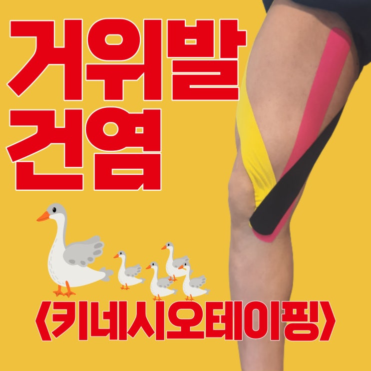거위발 건염에 도움이 되는 테이핑 방법 (무릎안쪽테이핑방법,키네시오테이핑, 스포츠테이핑) : 네이버 블로그