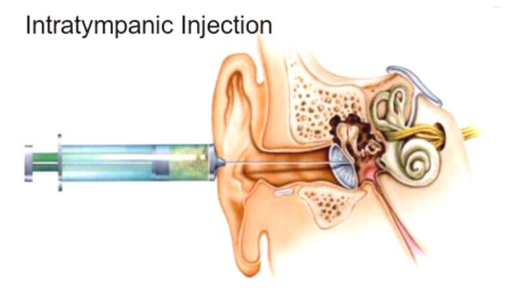 ITDI (Intratympanic Dexamethasone Injection) : 네이버 블로그