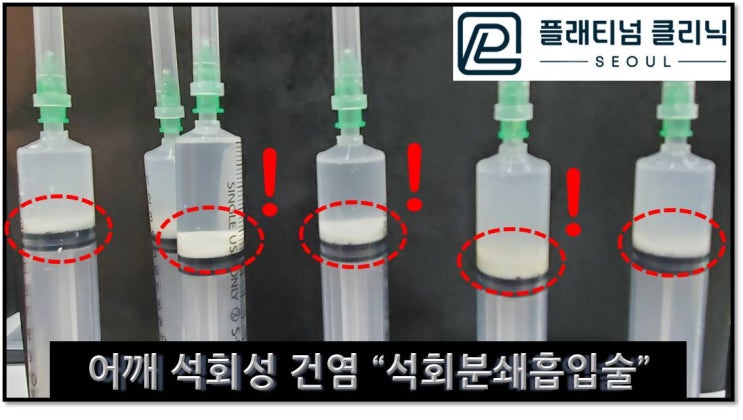 (플래티넘의원) 어깨 석회성 건염은 수술없이 치료할 수 있는 질환입니다.